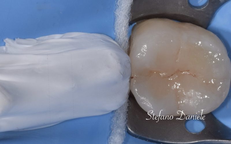 4 bis) odontoiatria protesica estetica posteriore